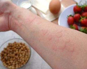 Allergy Blog Post